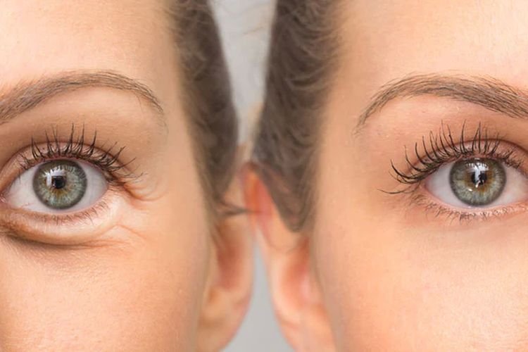 4 Rahasia Alami untuk Menghilangkan Kerutan di Bawah Mata, Cek Disini!