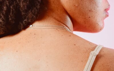 How Dermatologists Really Remove Skin Tags: Expert Tips Revealed
